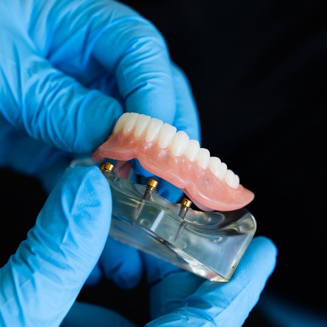 a person wearing blue gloves is holding a model of a denture with screws in it